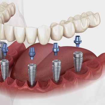 05-be-implant-basal