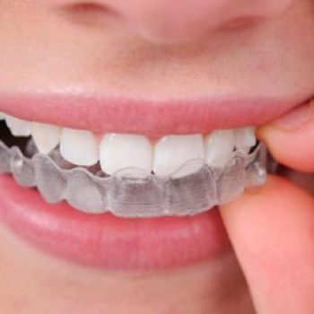 Aligner-Invisalign