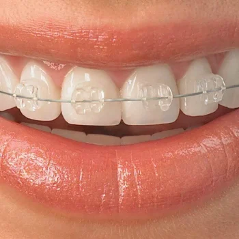 Invisalign-ceramic-braces-0