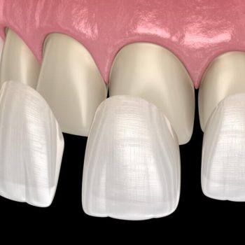 dental-veneers-cost-1080x675