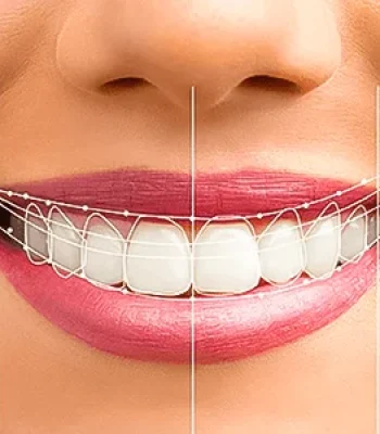 digital-smile-designing-delhi