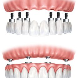 full-mouth-rehabilitation