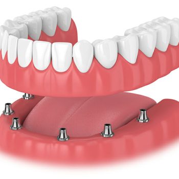 implantdentures