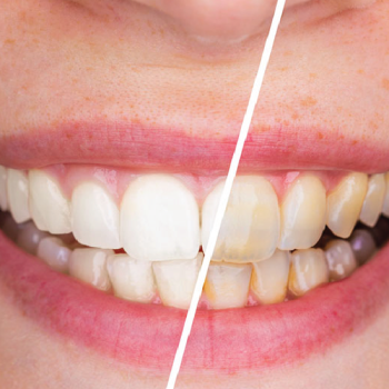 tooth-cleaning-scaling